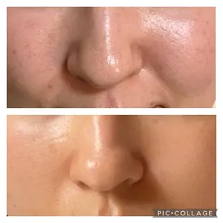 肌質改善🕊️ hirokoのエステ・リラクイメージ