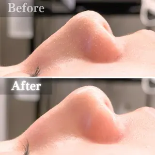 毛穴洗浄特化🫧 オオツカのエステ・リラクイメージ