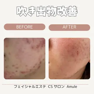 CSサロン Amule所属・🦋肌質改善サロン. anna🦋のエステ・リラクイメージ