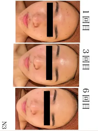 🔥3か月で肌革命 🔥ニキビ専門店のエステ・リラクイメージ