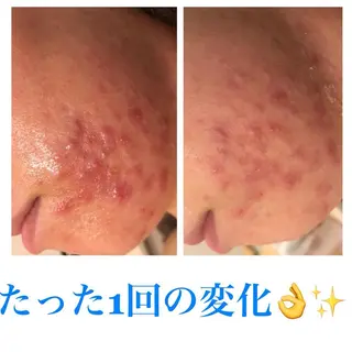 ミディアム カラー パーマ ヘアアレンジ メンズ ネイル マツエク・マツパ ニキビ・肌質改善専門 ♡人生が変わるサロンのエステ・リラクイメージ