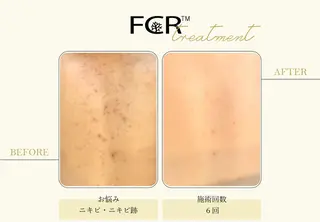 美容鍼灸/小顔鍼灸 肌質改善エステのエステ・リラクイメージ