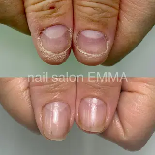 ネイル 広島市南区(広島県) /深爪/自爪育成のネイルデザイン