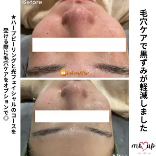 Meupニキビ専門店 背中/ハーブ/肌管理のその他イメージ