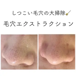 ニキビ&跡改善サロン オーナー光木のエステ・リラクイメージ