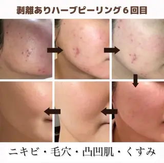 美肌ケアサロンhalu【ハーブピーリング/脱毛】所属・美肌ケアサロン halu（ハル）のその他イメージ