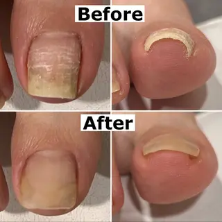 ネイル Mellow nail所属・巻爪無料モデル募集 ✨🦶MEGUMIのネイルデザイン