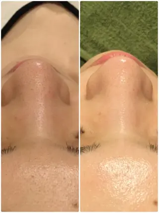 【リベルハーブピーリング認定店】敏感肌・美白脱毛専門店Dione立川店所属・Dione 立川店のエステ・リラクイメージ