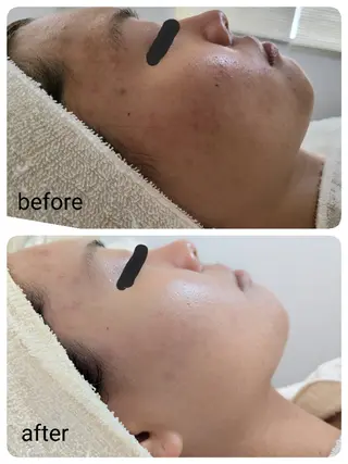 レチノール/ニキビ/ 毛穴ケア 浅川のエステ・リラクイメージ