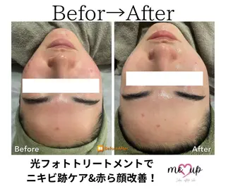 Meupニキビ専門店 背中/ハーブ/肌管理のその他イメージ