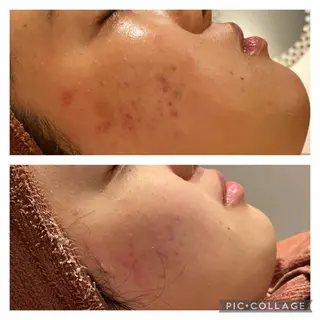 セミロング カラー パーマ ヘアアレンジ メンズ キッズ ネイル マツエク・マツパ アイブロウ ニキビ特化型エステ 🍓最短で肌質改善のエステ・リラクイメージ