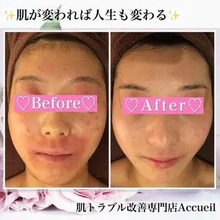 ニキビ・肌質改善専門 ♡人生が変わるサロンのエステ・リラクイメージ