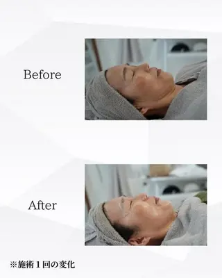 ハーブピーリング🌿 REVI/Ayanoのエステ・リラクイメージ