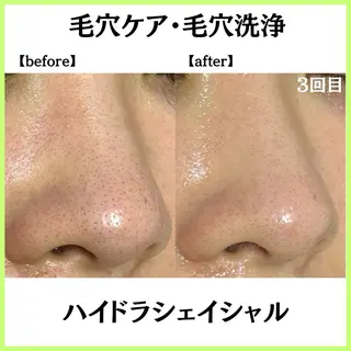 小顔ハーブピーリング 美容鍼/毛穴洗浄のエステ・リラクイメージ