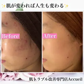 ミディアム カラー パーマ ヘアアレンジ メンズ キッズ ネイル マツエク・マツパ アイブロウ ニキビ・肌質改善専門 ♡人生が変わるサロンのエステ・リラクイメージ