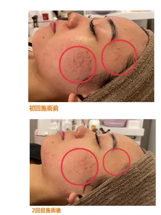 メンズ 肌改善/まつげパーマ 🌙Luunaのエステ・リラクイメージ