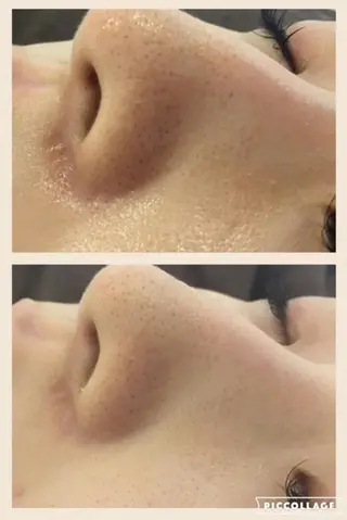 夏までに肌荒れ卒業 するサロン🌻のエステ・リラクイメージ