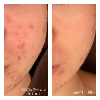 ロング カラー パーマ ヘアアレンジ メンズ キッズ ネイル マツエク・マツパ ニキビ跡専門サロン Ainaのエステ・リラクイメージ