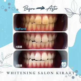 セルフホワイトニングサロンKiratt札幌店💎所属・Kiratt 札幌店のその他イメージ