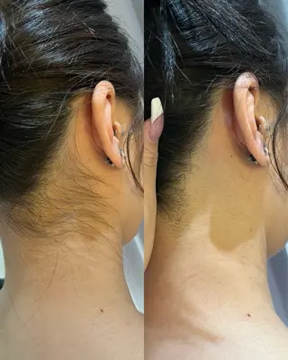 うなじ脱毛/美肌脱毛 LABELのエステ・リラクイメージ