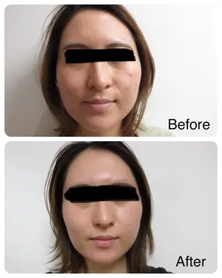 【赤ニキビ改善】 BELL'ET新宿店のエステ・リラクイメージ