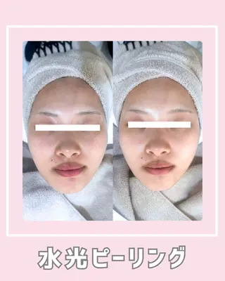 |ピーリング・毛穴| soina神楽坂のエステ・リラクイメージ