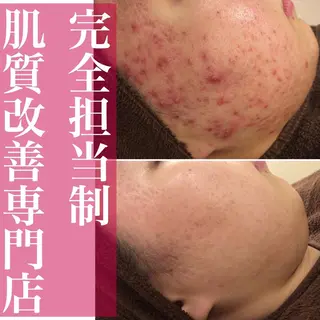 ニキビ跡改善専門🔥 医療にはできない改善のエステ・リラクイメージ