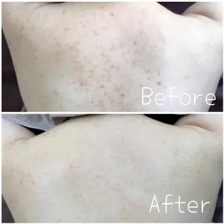 医療提携×美容整体 小顔ハイフピーリングのエステ・リラクイメージ