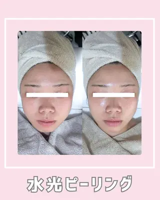 |ピーリング・毛穴| soina神楽坂のエステ・リラクイメージ