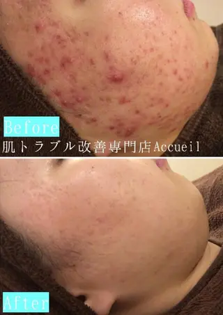 夏までに肌荒れ卒業 するサロン🌻のエステ・リラクイメージ