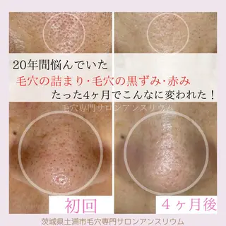毛穴ケア専門サロンアンスリウム所属・茨城土浦 つくば毛穴 ケア専門サロンのエステ・リラクイメージ