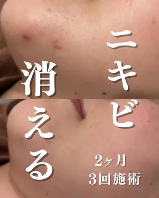 学生ニキビ改善🍀 優しい肌質改善のエステ・リラクイメージ