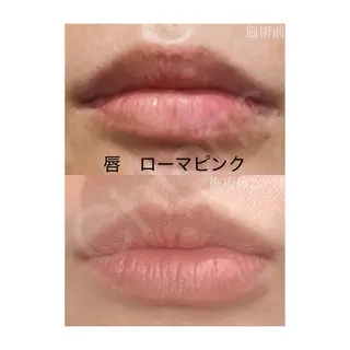 川越ローマピンク 光脱毛＆ワックス脱毛のエステ・リラクイメージ