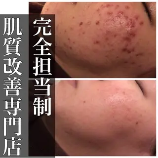 🔥3か月で肌革命 🔥ニキビ専門店のエステ・リラクイメージ