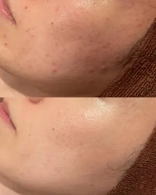 学生ニキビ改善🍀 優しい肌質改善のエステ・リラクイメージ