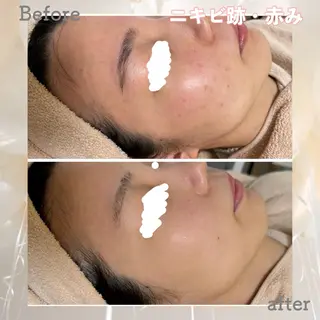 ニキビ&跡改善サロン オーナー光木のエステ・リラクイメージ