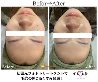 Meupニキビ専門店 背中/ハーブ/肌管理のその他イメージ