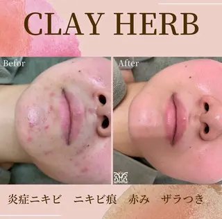 VIKI BEAUTY  クレイハーブピーリング・美肌脱毛専門店所属・VIKI BEAUTYのエステ・リラクイメージ