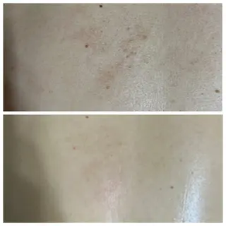 【ハーブピーリング】 Allumentのエステ・リラクイメージ