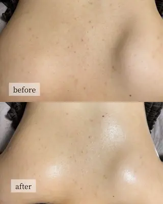 HINANO矢場町店【ヒナノ】所属・脱毛/肌改善🌿 HINANO 村田のエステ・リラクイメージ