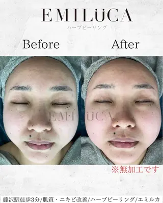 ハーブピーリング専門EMILUCA藤沢所属・ハーブピーリング /KAEDEのエステ・リラクイメージ