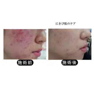 渋谷 小顔美容鍼 専門サロン YZのエステ・リラクイメージ