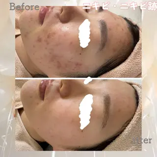 ニキビ&跡改善サロン オーナー光木のエステ・リラクイメージ