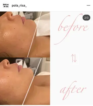 韓国/ピーリング 毛穴洗浄/POLAのエステ・リラクイメージ