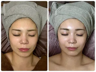 小顔ハーブピーリング 美容鍼/毛穴洗浄のエステ・リラクイメージ