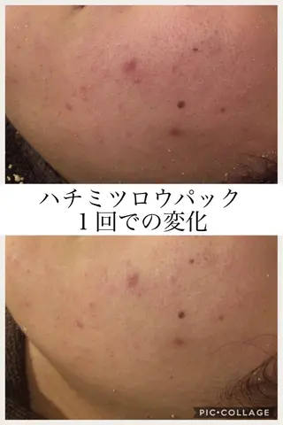 ニキビ・肌質改善専門 ♡人生が変わるサロンのエステ・リラクイメージ