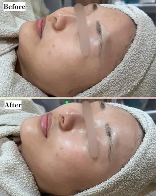 |ピーリング・毛穴| soina神楽坂のエステ・リラクイメージ