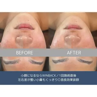 himee所属・艶肌ハーブピーリング /毛穴洗浄のエステ・リラクイメージ