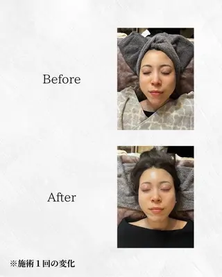 ハーブピーリング🌿 REVI/Ayanoのエステ・リラクイメージ