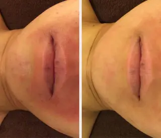 学生ニキビ改善🍀 優しい肌質改善のエステ・リラクイメージ